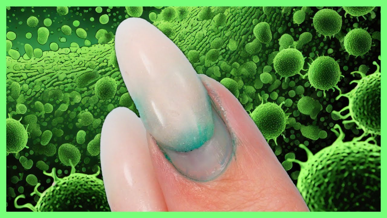 Green Nail Syndrome (GNS, Pseudomonas nail infection, chloronychia, green  striped nails, chromonychia) - Dermatology Advisor