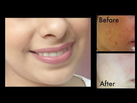 How to Get Rid of Dark Spots, Acne Scars | Get Fairer & Clear Skin