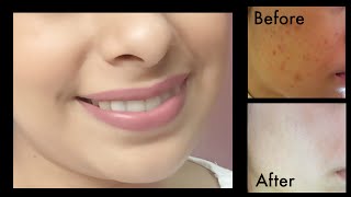 How to Get Rid of Dark Spots, Acne Scars | Get Fairer & Clear Skin