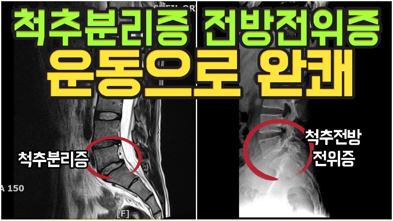 퇴행성 디스크 파열, 디스크 치료.수술과 척추 분리증. 척추 전방 전위증의 치료 원인, 증상, 증상, 약, 주사. 수술, 운동, 척추 전방 전위증 수술. 척추 고정술 예방 및 완치 후기 12