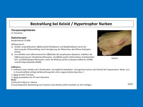 Video: Unterschied Zwischen Keloid Und Hypertropher Narbe