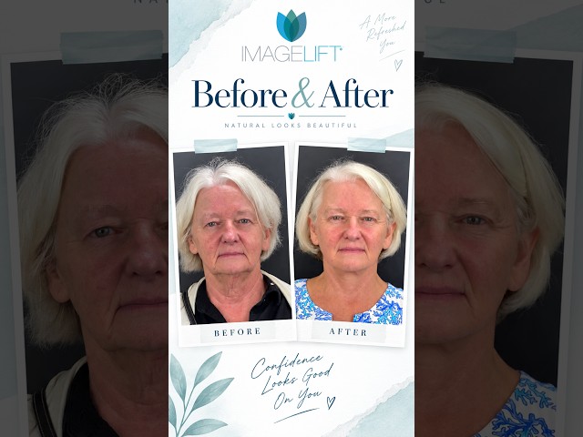 Martha Wanted a Natural, Subtle Facelift Result #imagelift #deeplift #facelift #beforeandafter