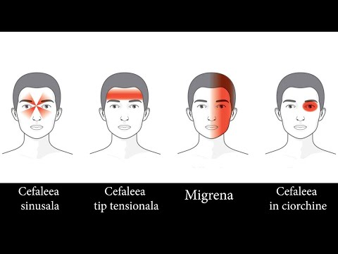 Video: 4 moduri de a face față migrenelor