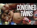 The heartwarming story of Trishna &amp; Krishna: Conjoined twins separated