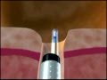 Laser hemorrhoidoplasty  animation view