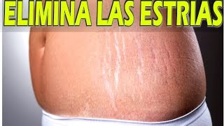 Como ELIMINAR LAS ESTRÍAS en poco tiempo l Mira estos trucos para quitar  las estrías rápido - YouTube