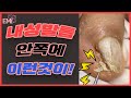 무좀으로 구겨진내성발톱 펼치면❌ 살을 찌르고있는 왕건이 썩은발톱만 깨끗하게 잘라주고 이쁘게 자라도록 해드림.