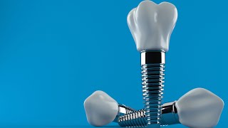 Announcing A New Dental Implants EBook from The Dental Views