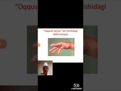 Video: Reiter sindromu - patogenezi, simptomları, diaqnozu, müalicəsi, proqnozu
