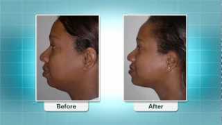 Chin Augmentation is Hottest Trend In Plastic Surgery