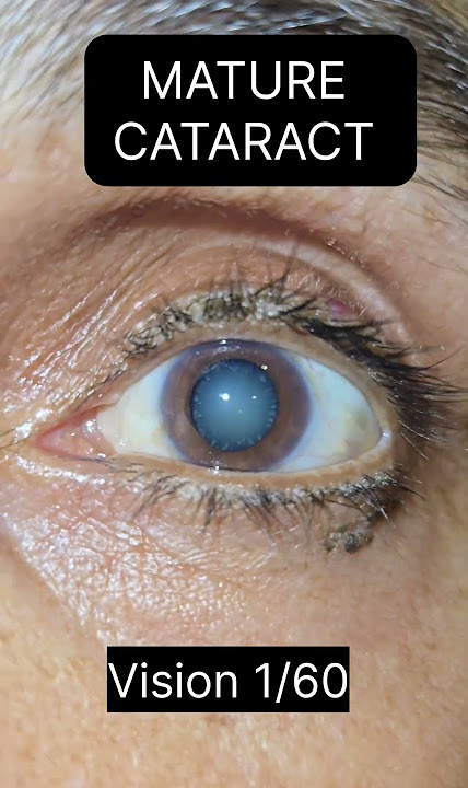Vision in different Eye Conditions