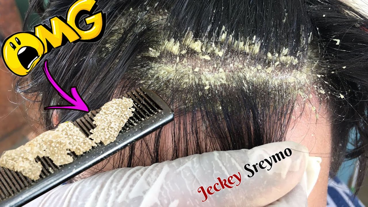 Dandruff Big Flakes Scratching Around Ear 527 YouTube