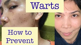 Paano Mawala Ang Warts O Kulugo? Mabisang Paraan Sa Pagtanggal Ng Warts? How To Prevent Warts? Paano Mawala Ang Warts O Kulugo? Mabisang Paraan Sa Pagtanggal Ng Warts? How To Prevent Warts?