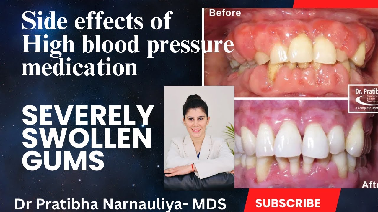 High Blood Pressure Medicine Causing Severe Swelling In Gums Dr High Blood Pressure Medicine Causing Severe Swelling In Gums Dr
