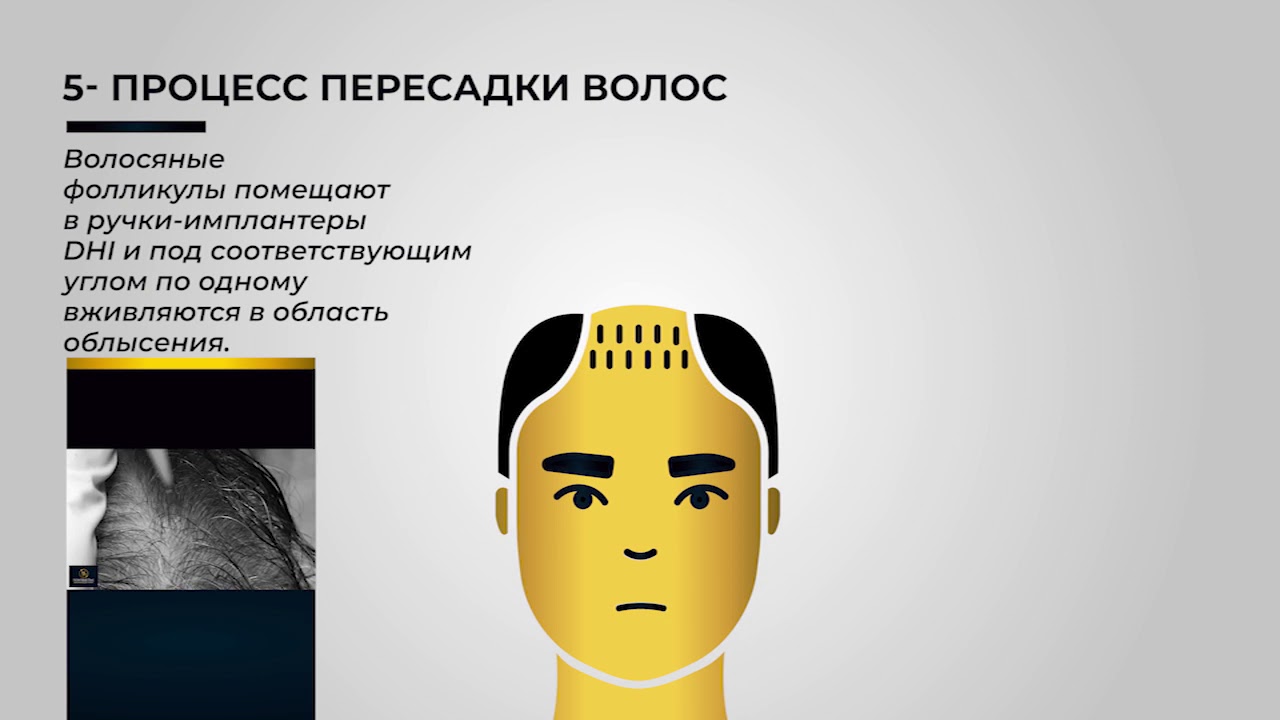 Метод пересадки волос DHI