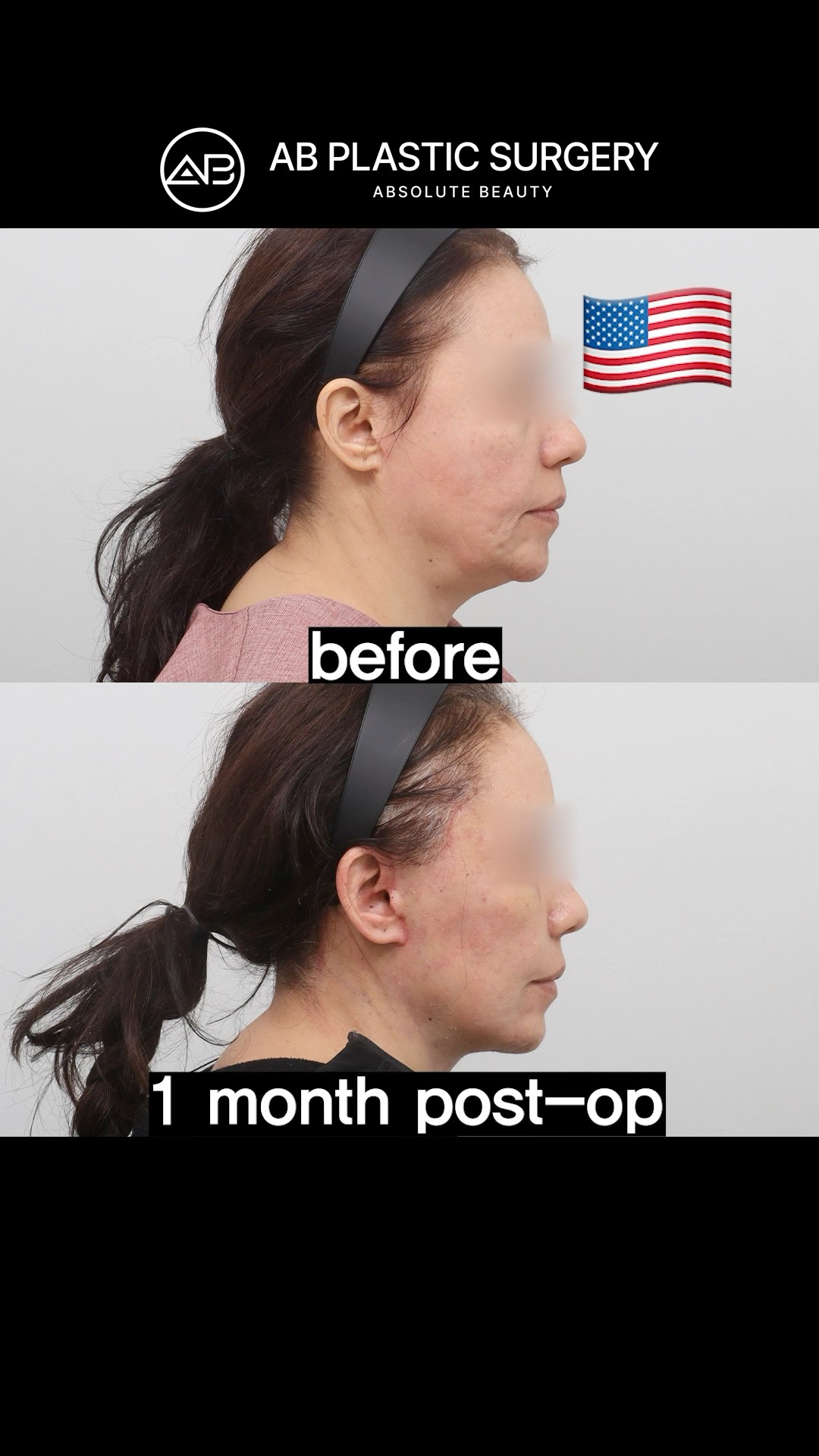 Facelift Results After 1 Month – Dramatic Change! #koreanplasticsurgery