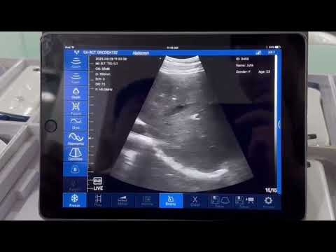 Viatom Handheld ultrasound