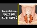 Tracheal Stenosis क्या है और इसके लक्षण ? | What are its symptoms?