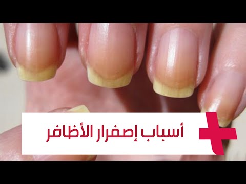 قد تكون نتيجة مشاكل صحية أخصائي يكشف أسباب إصفرار الأظافر