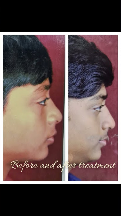 phase 1 and phase 2 orthodontic treatment by Dr.Ashim Roy