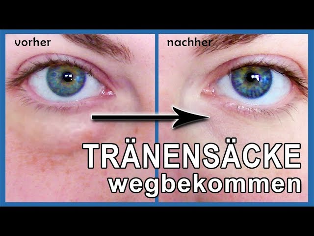Tranensacke Und Augenringe Wegbekommen Mit Backpulver Dieses Hausmittel Wirkt Youtube