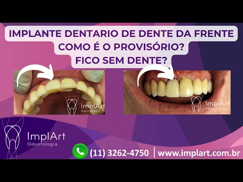 IMPLANTE DENTARIO DENTE