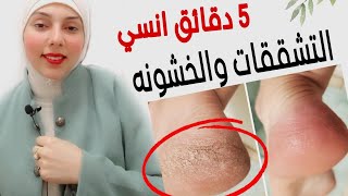 The Ultimate Solution for Cracked Heels: Soften Your Feet After Just One Use screenshot 5
