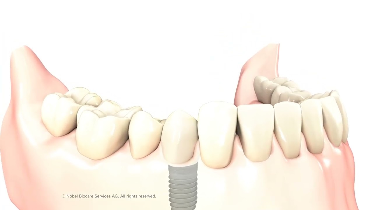 Implantes dentales Odontosur.com.mx