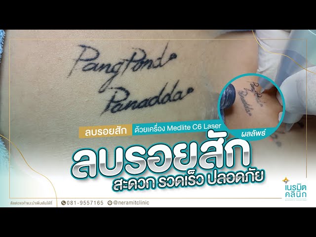 ลบรอยสัก EP.54/ลบรอยสัก จะสักชื่ออะไรมาก็ลบได้^^ @หมอปุ๊ Neramit Clinic