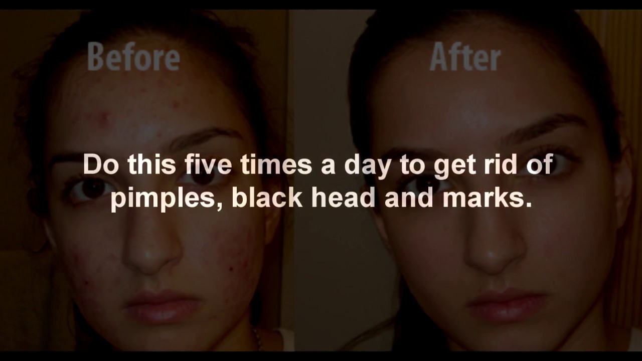 Top 10 Home remedies for clear skin YouTube