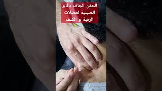 الحقن الجاف بالابر الصينية لعضلات الرقبة و الكتف rehabilitation علاج_طبيعي التأهيل الابهر الكتف