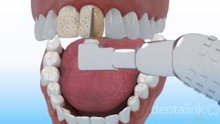 CARILLA DENTAL [estética anterior] - Video 3D paso a paso