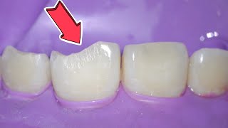 Broken Tooth Fixed With Bonding!