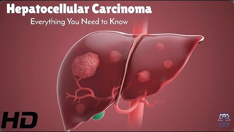 Fighting Hepatocellular Carcinoma: Key Facts