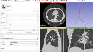 Finding shortest path between two points in the bronchial tree