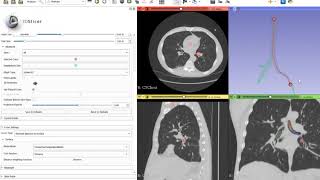 Finding shortest path between two points in the bronchial tree