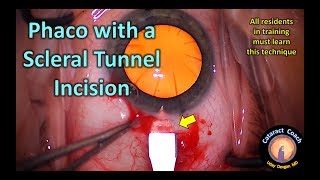 How to make a Scleral Tunnel incision for Cataract Surgery