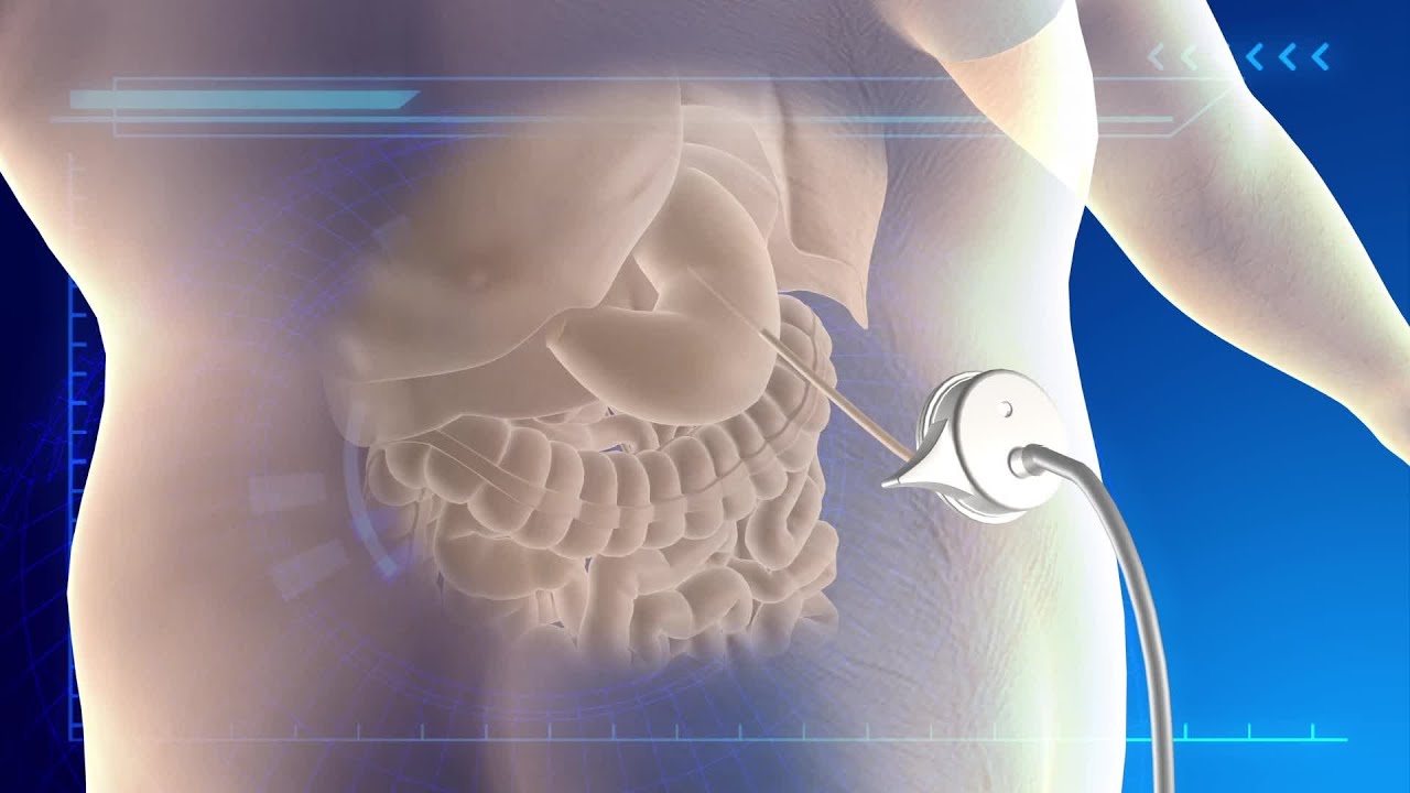 FDA approves ‘abdominal vomiting’ weightloss device YouTube