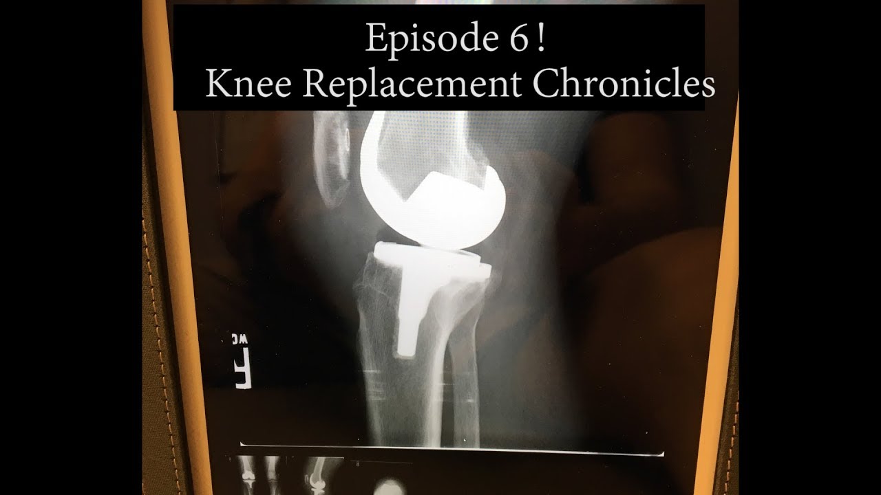 Knee Replacement Chronicles Episode 6, Crutches to Cane YouTube