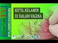 Kutil Kelamin di dalam Vagina Bagaimana Cara Mengobatinya?