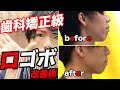 【歯科矯正級】自ら実践済み!!口ゴボ（口の出っ張り）を改善する自力矯正法