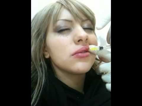 lip-fillers-dermal-fillers-sydney-cosmetic-surgery-clinic-sheraton-hotel