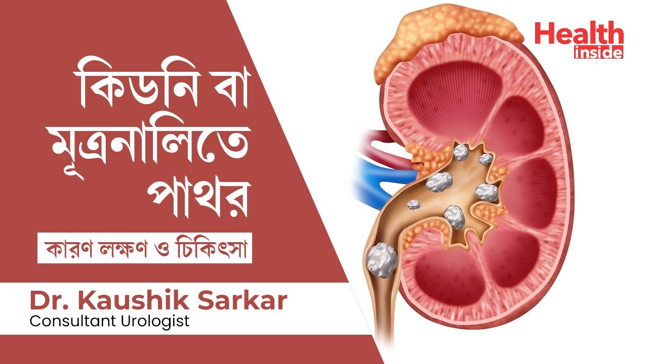 কিডনি পাথরের কারণ ও প্রতিকার: সহজ ও কার্যকর উপায়