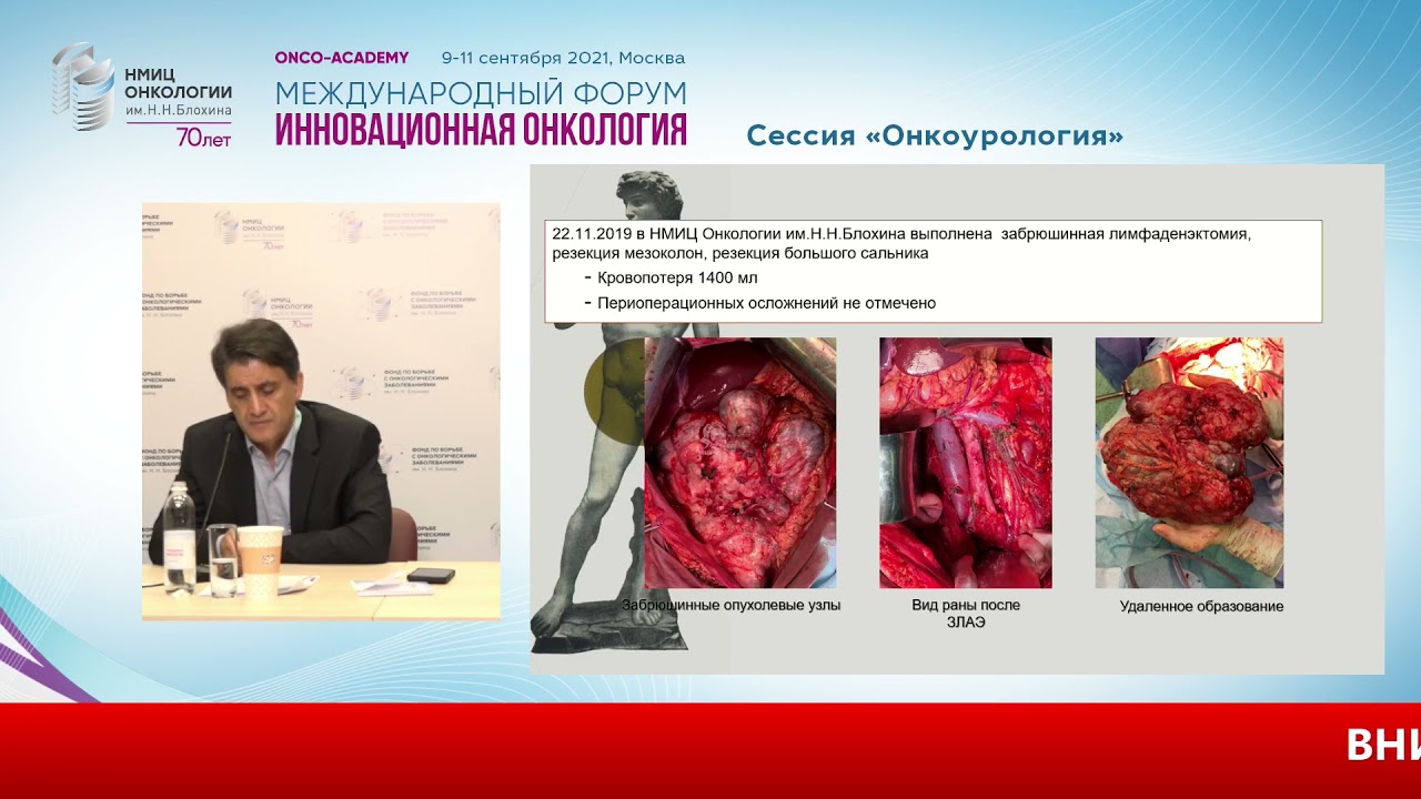 Забрюшинная лимфаденэктомия у больных герминогенными опух. яичка с неполным эффектом химиотерапии.