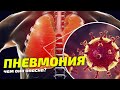 Что такое пневмония и чем она опасна / Симптомы Пневмонии