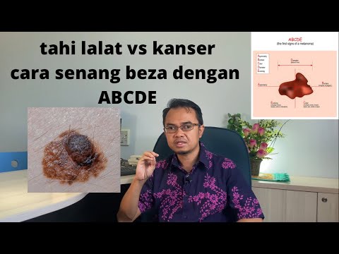 Tahi lalat atau kanser kulit? cara senang beza dengan ABCDE