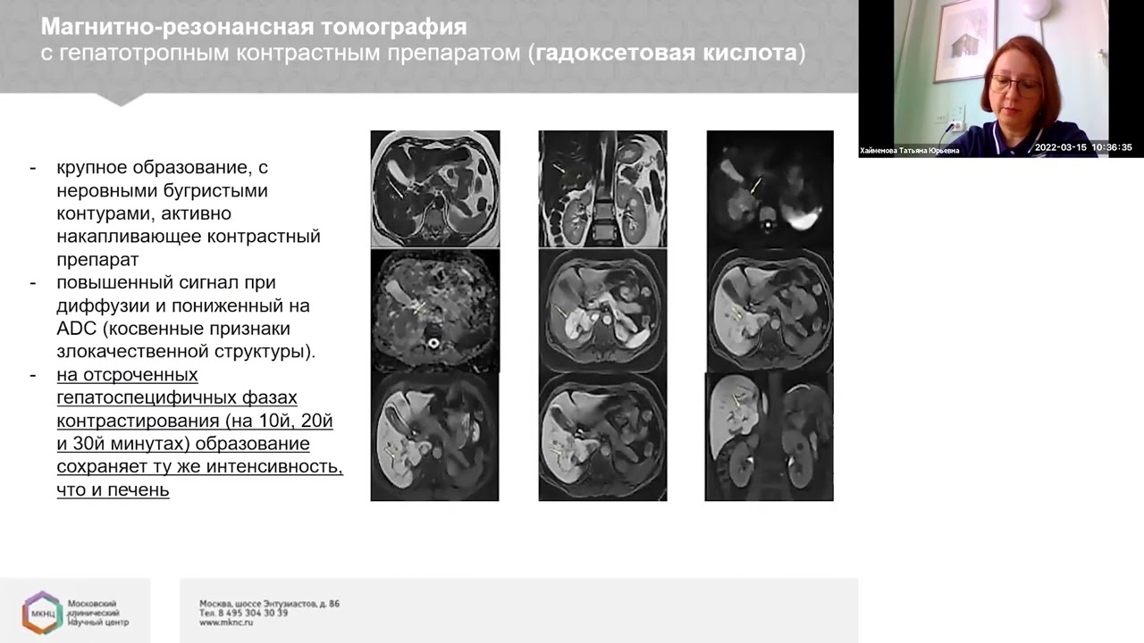 Эстроген индуцированная фокально-нодулярная гиперплазия - миф или реальность?