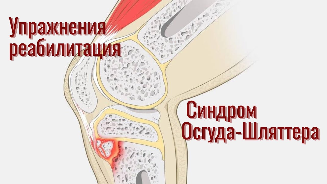 Синдром Осгуда-Шляттера у детей и подростков. Предупреждение, лечение ...