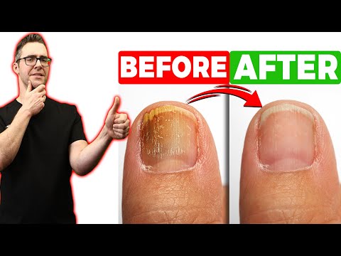 Video: 4 Ways to Treat Broken Nails