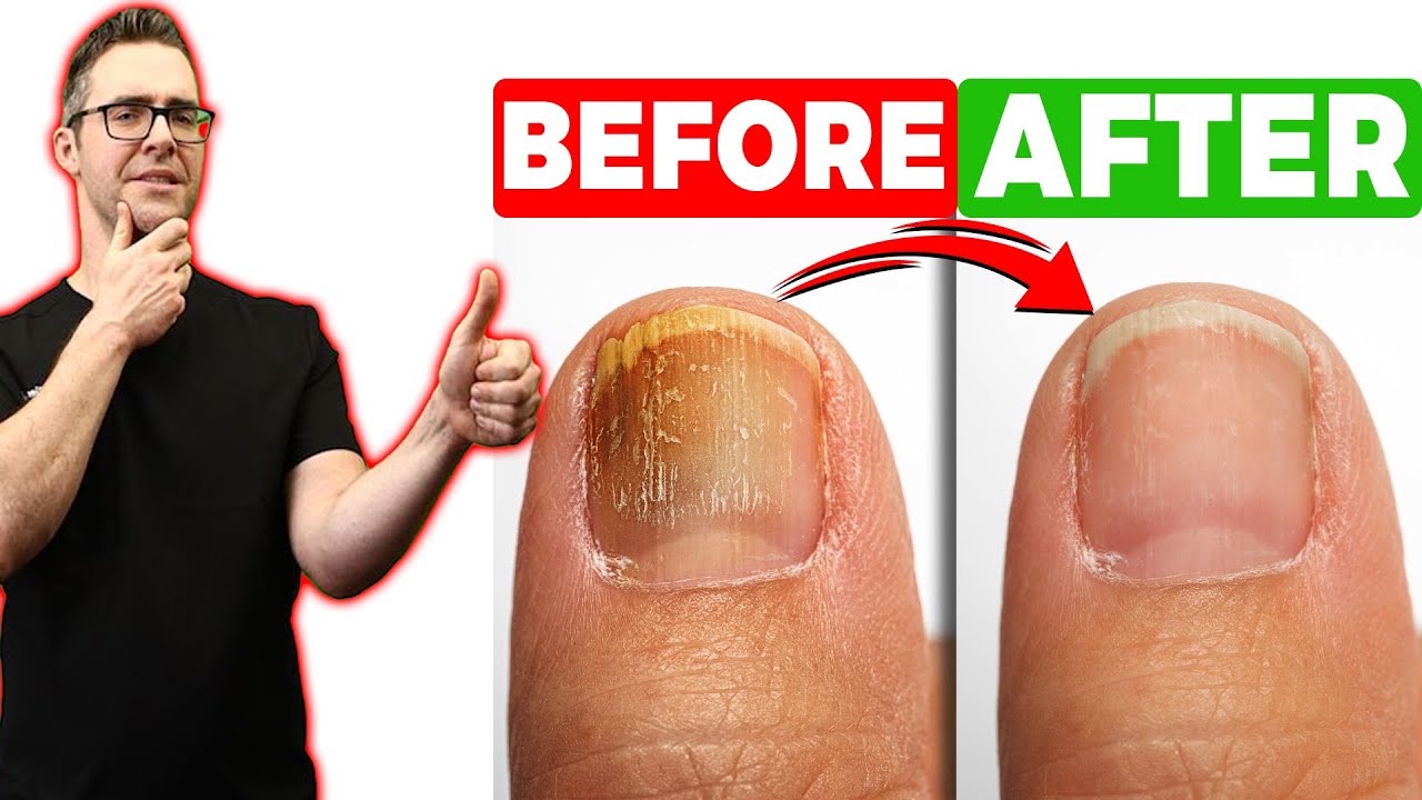 Nails: Infections, anemia, psoriasis: What nails can reveal about your  health - The Economic Times